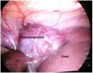 haemangioma