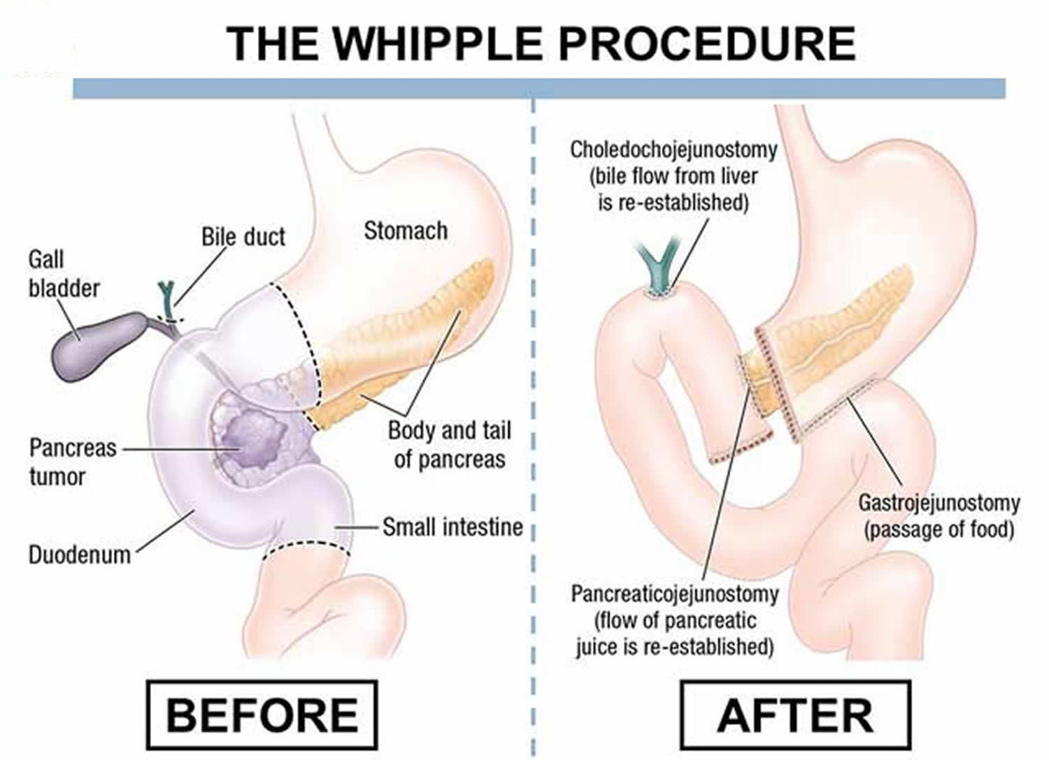 Whipple_procedure